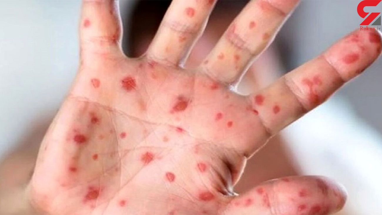 132 بیمار مبتلا به سرخک در کشور شناسایی شدند 132 بیمار مبتلا به سرخک در کشور شناسایی شدند