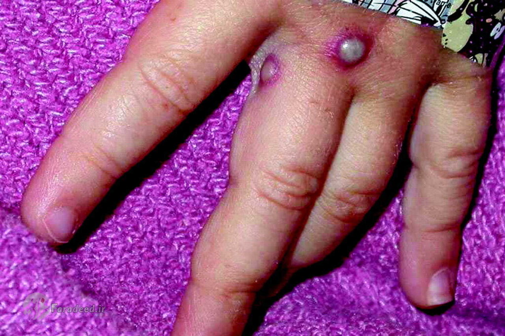 علوم پزشکی ایرانشهر: فوت یک شهروند ایرانشهری براثر ابتلا به آبله میمون صحت ندارد علوم پزشکی ایرانشهر: فوت یک شهروند ایرانشهری براثر ابتلا به آبله میمون صحت ندارد