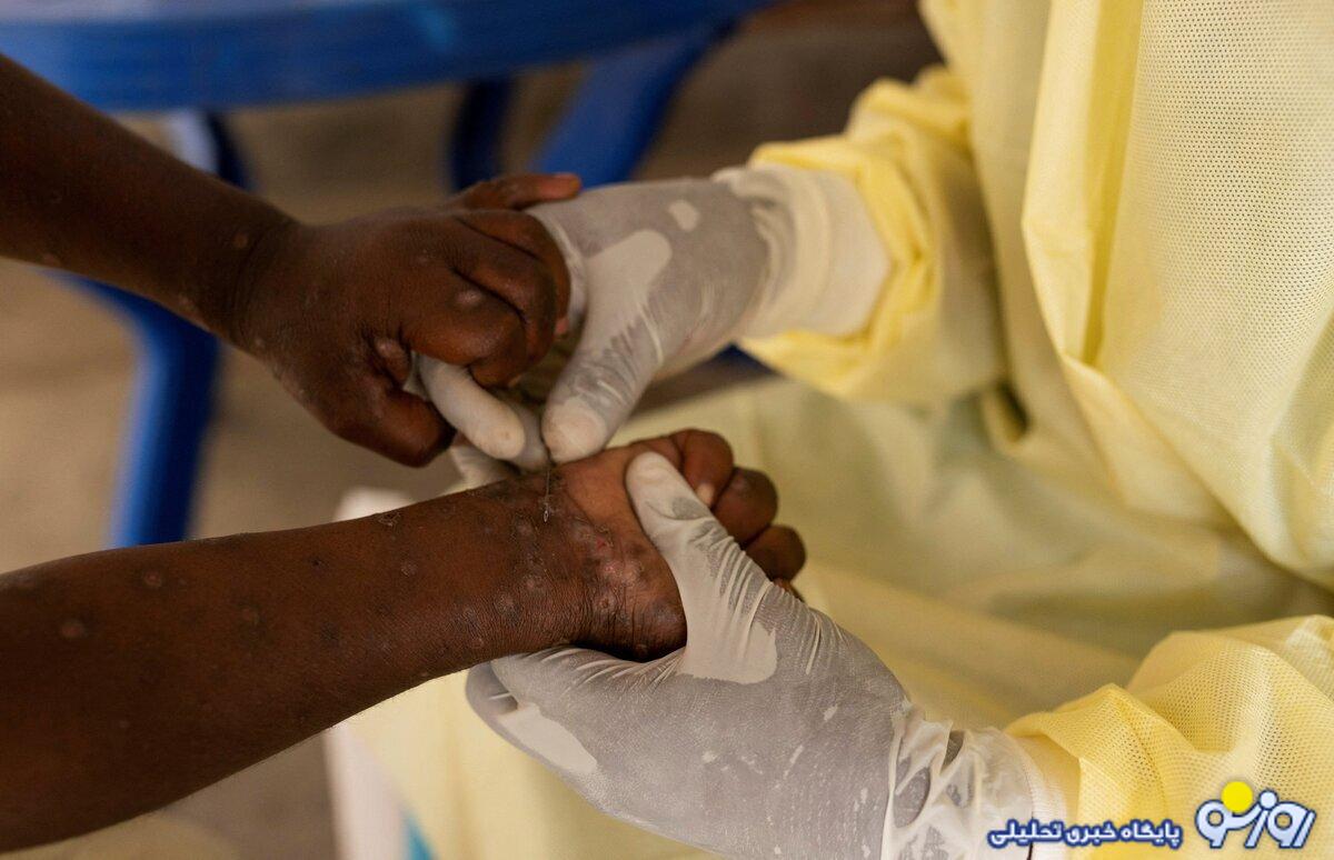 هشدار؛ آبله میمونی در کمین است هشدار؛ آبله میمونی در کمین است